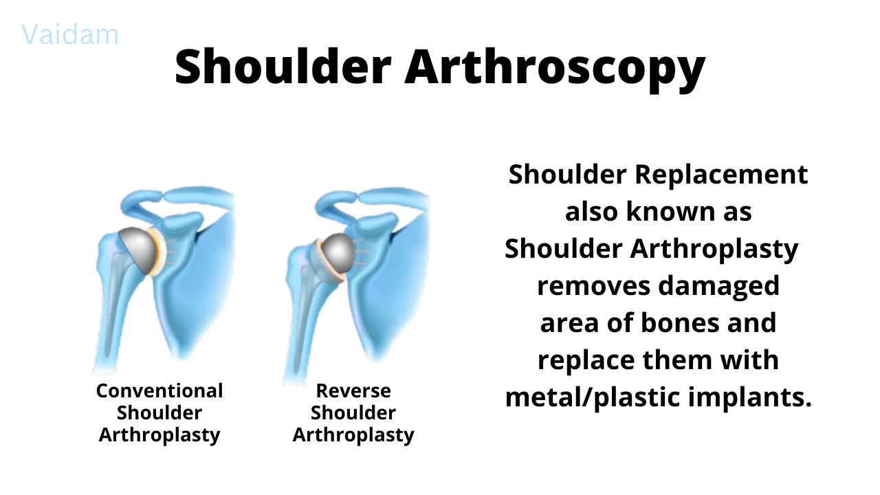  What is Shoulder Arthroscopy?