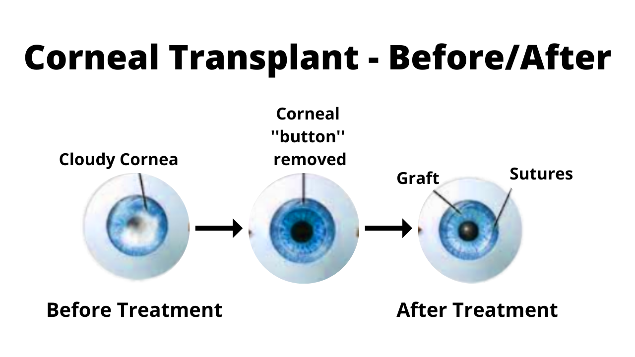  Before and after Cornea Transplant.
