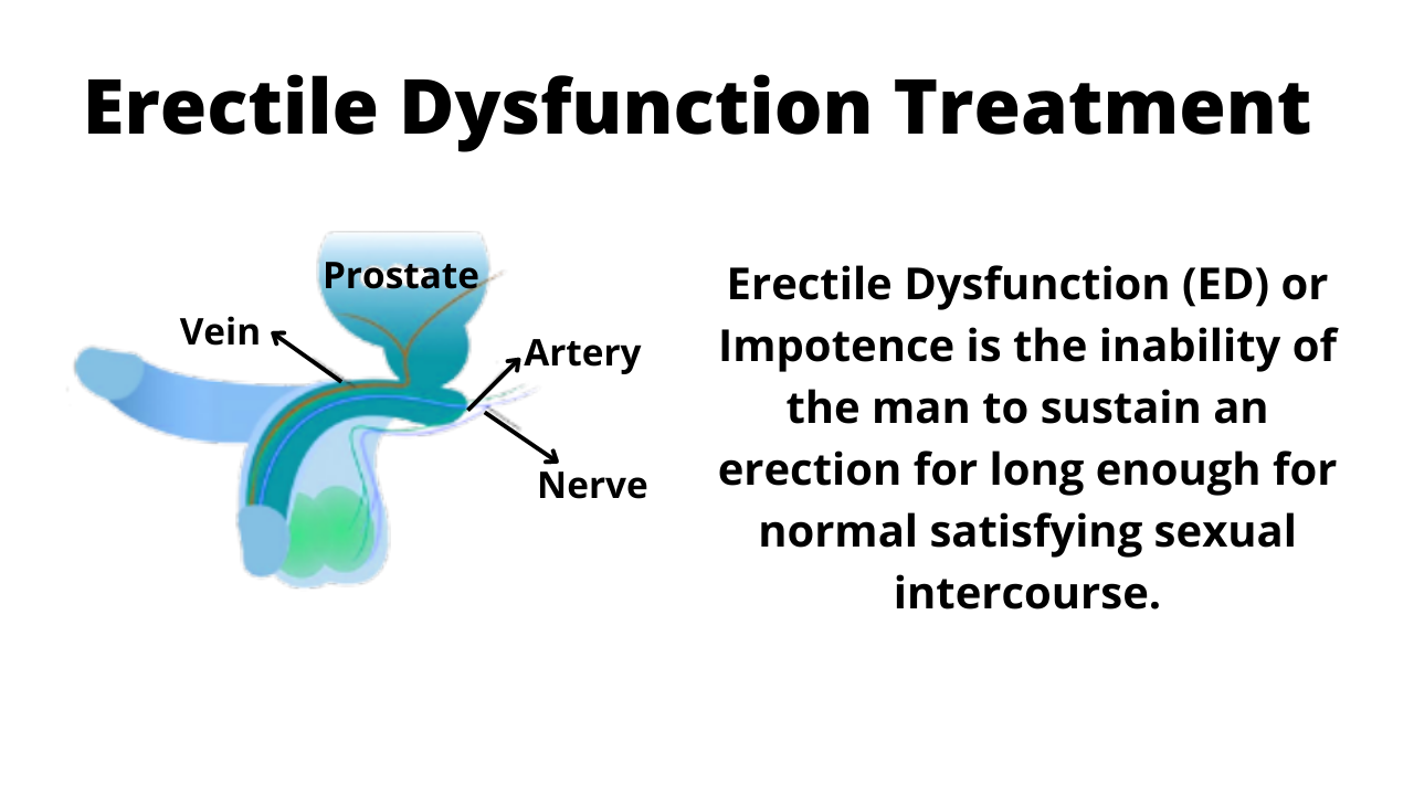  What is Erectile Dysfunction treatment?