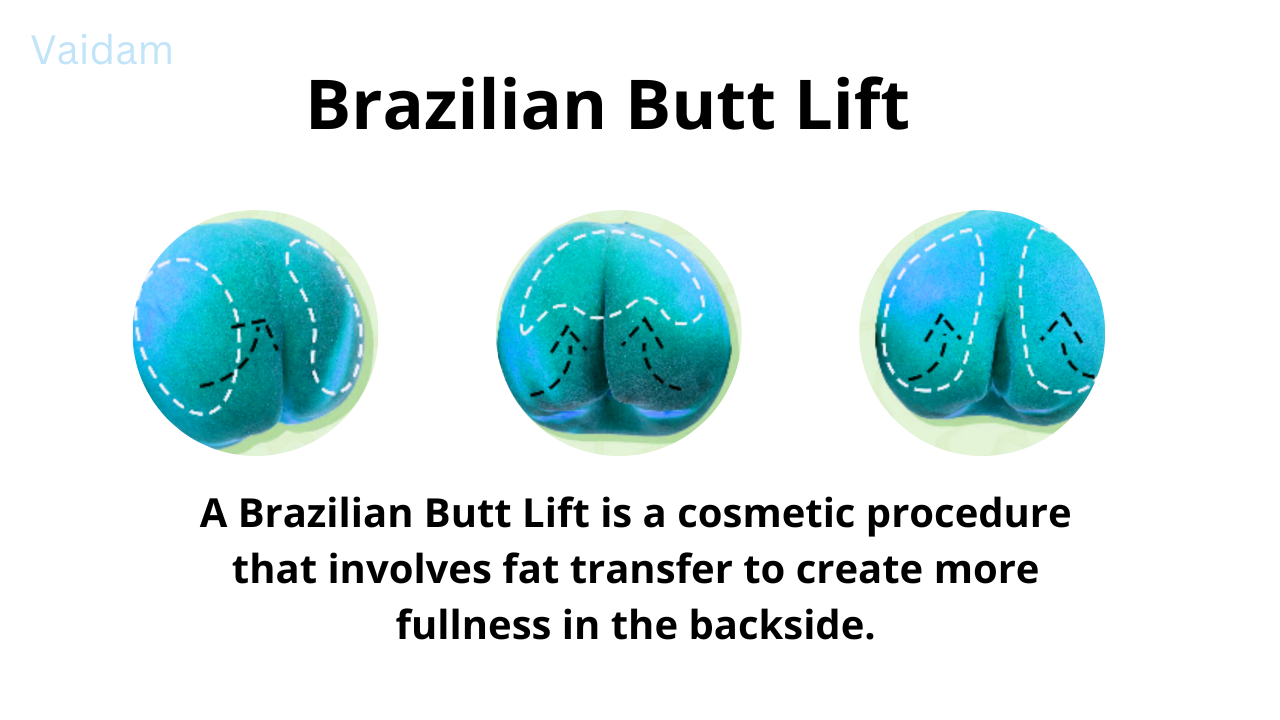 What is Brazilian Butt Lift treatment?