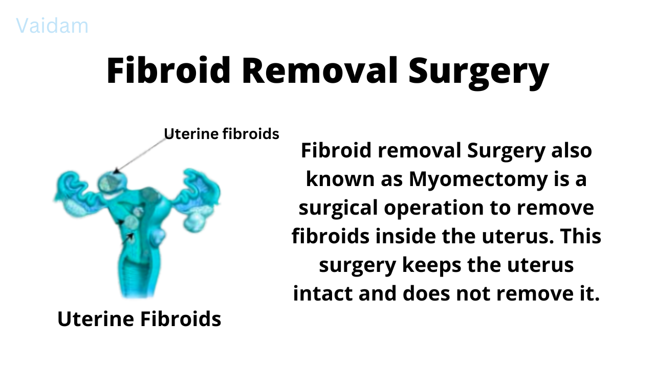 Fibroid Removal Surgery.
