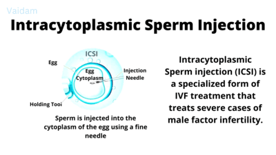¿Qué es la inyección intracitoplasmática de esperma (ICSI)?