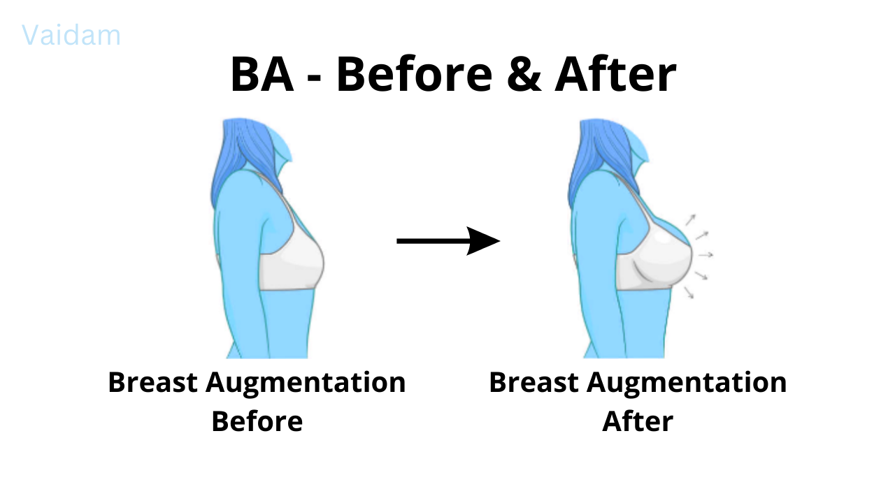 Before and after the Breast Augmentation process.