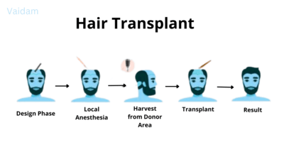  Hair Transplantation process.