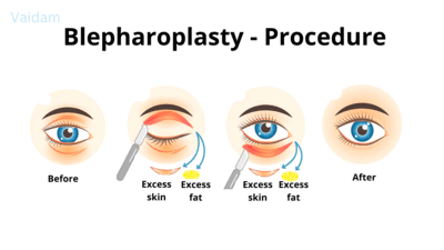 ब्लेफेरोप्लास्टी सर्जरी की प्रक्रिया।
