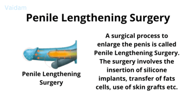 Penile Lengthening Surgery