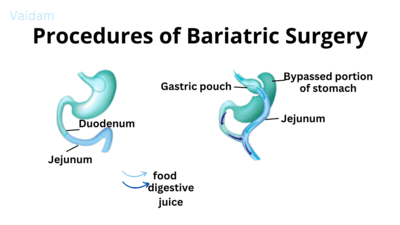 Procedures involved in Bariatric surgery.