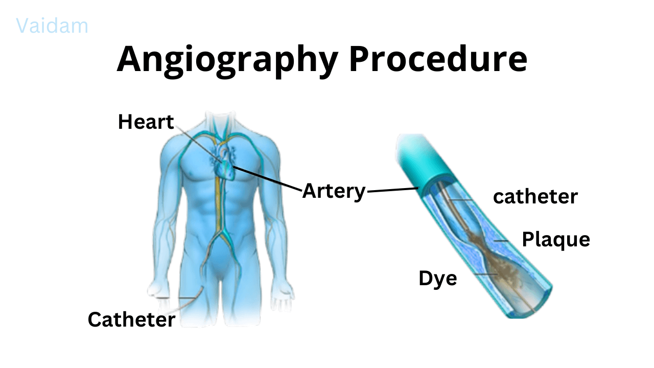 The procedure of Angiography.