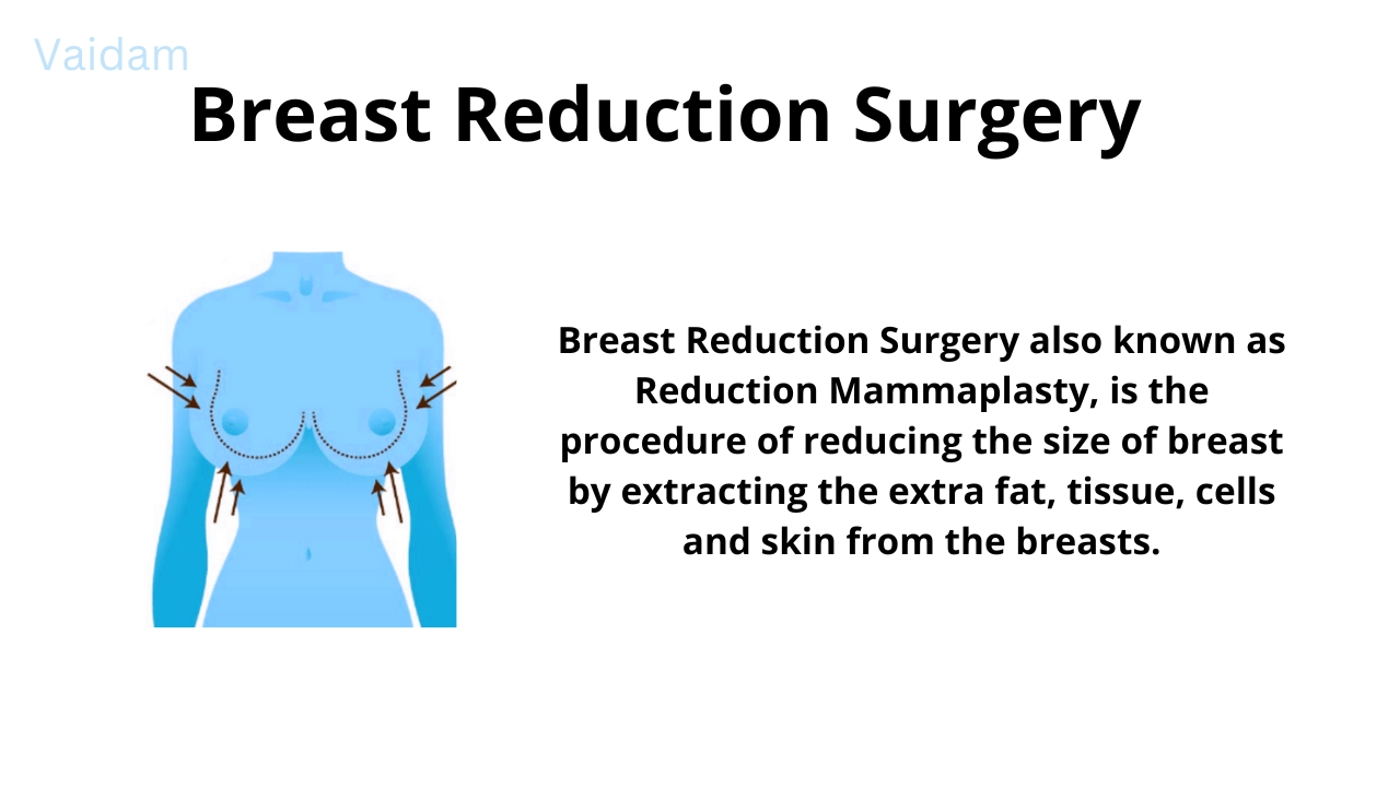 À propos de la chirurgie de réduction mammaire.