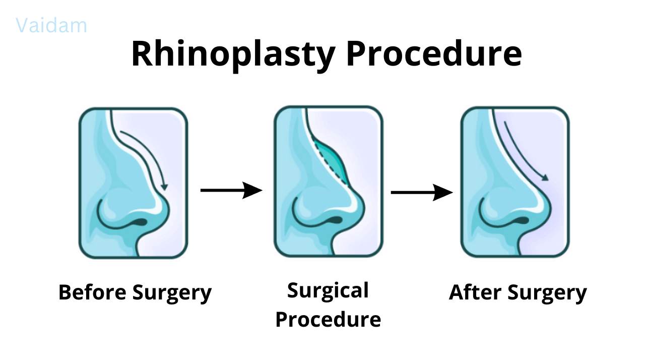 Rhinoplasty- Overview