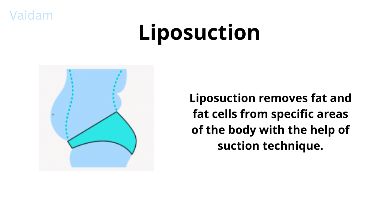  Liposuction surgery.