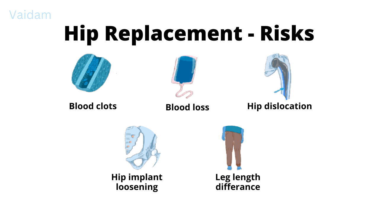  Risks of Hip Replacement Surgery.