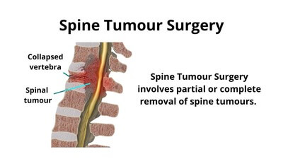 Spine Tumor Surgery