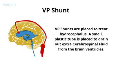What is VP Shunt?