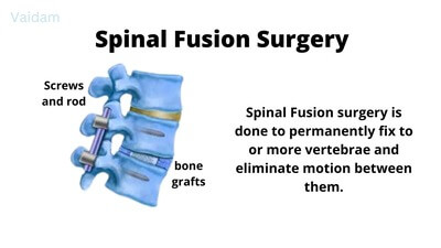 What is Spinal Fusion Surgery?