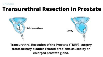 What is Transurethral Resection in the Prostate (TURP)?