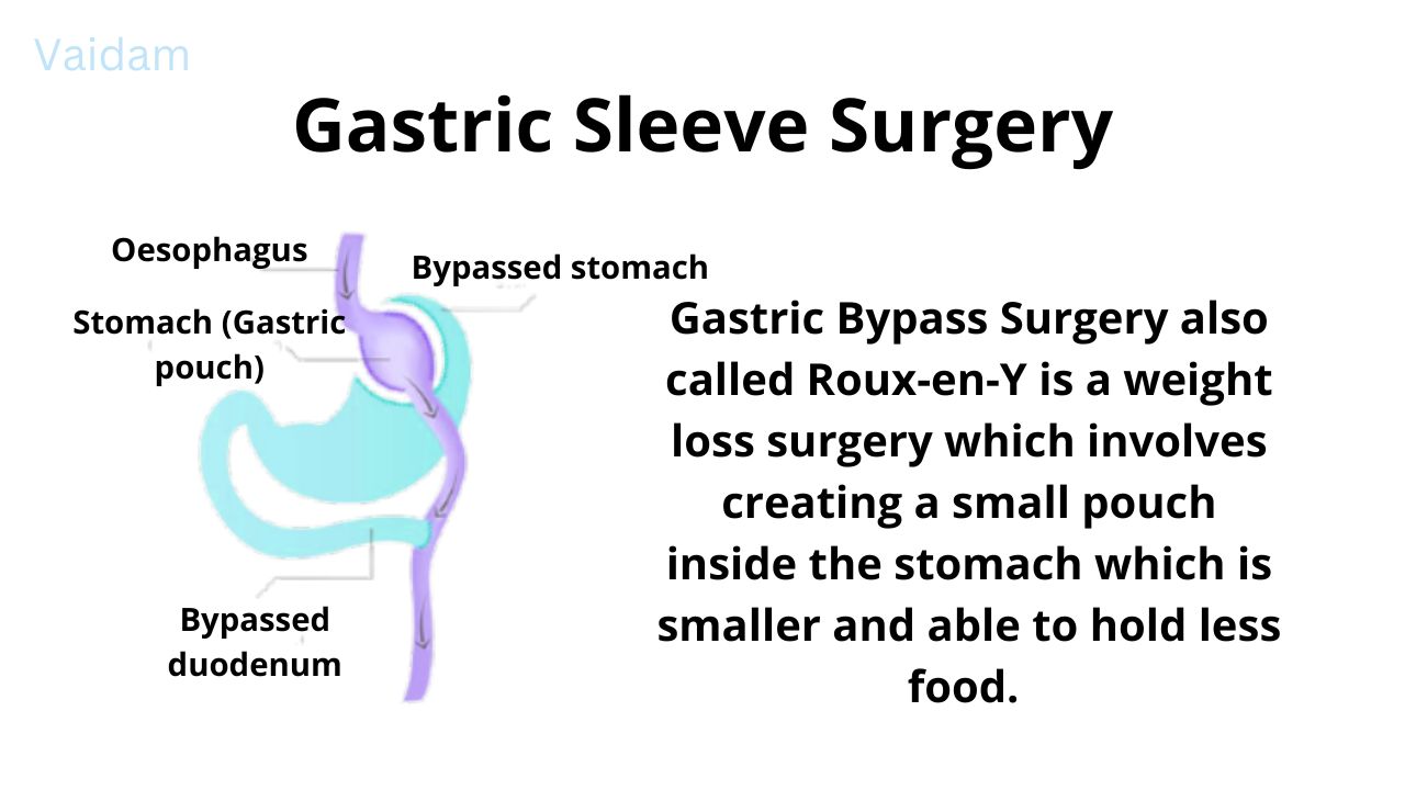  What is Gastric Sleeve Surgery