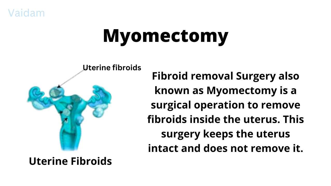  What is Myomectomy?