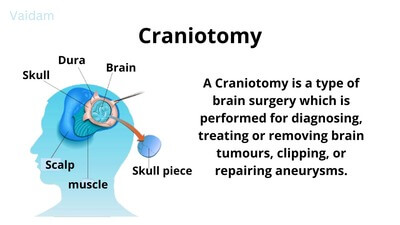 What is Craniotomy?