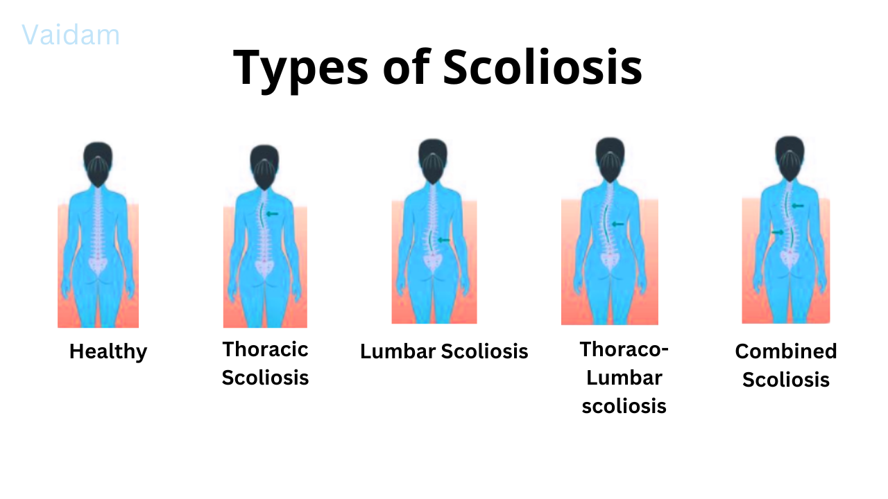  Types of Scoliosis.