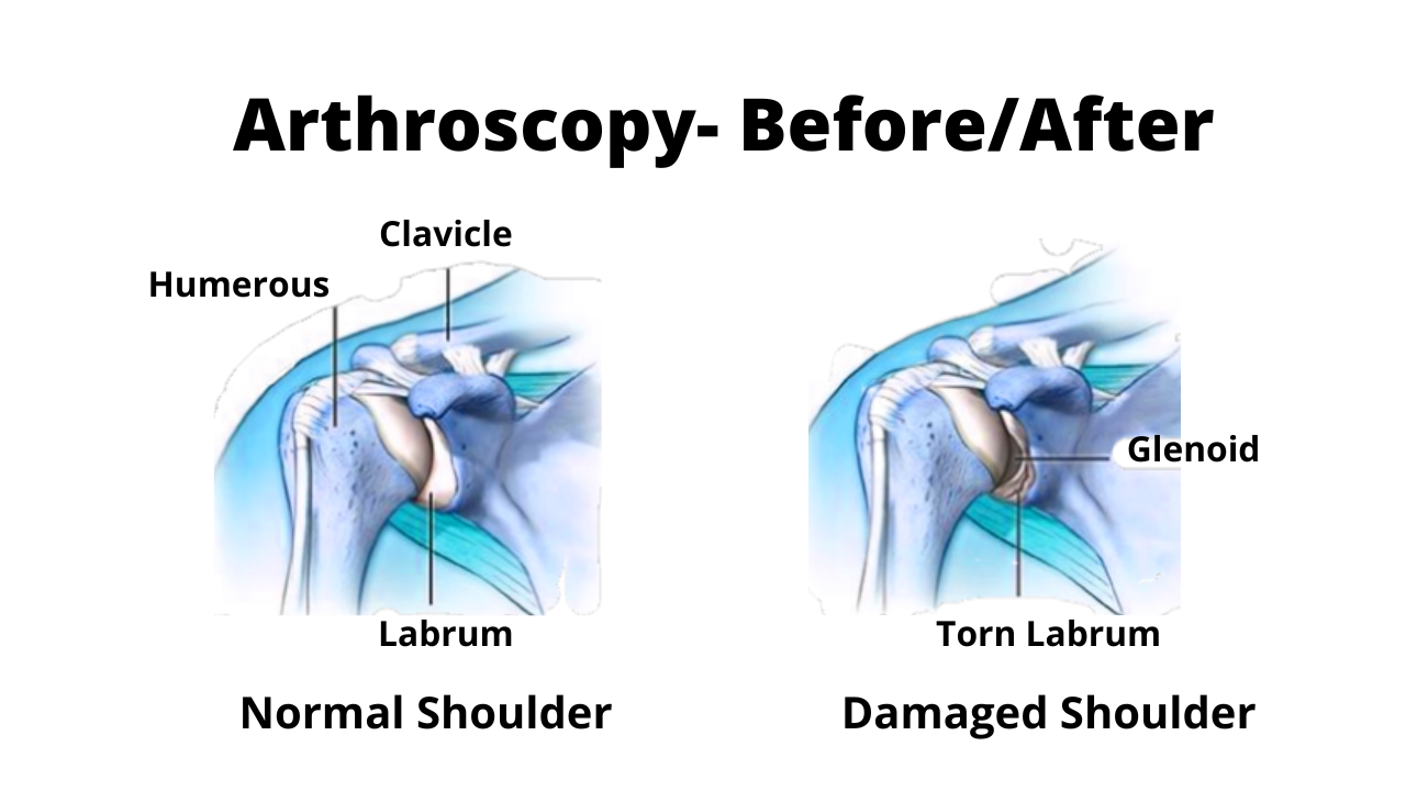 Before and after shoulder arthroscopy surgery.
