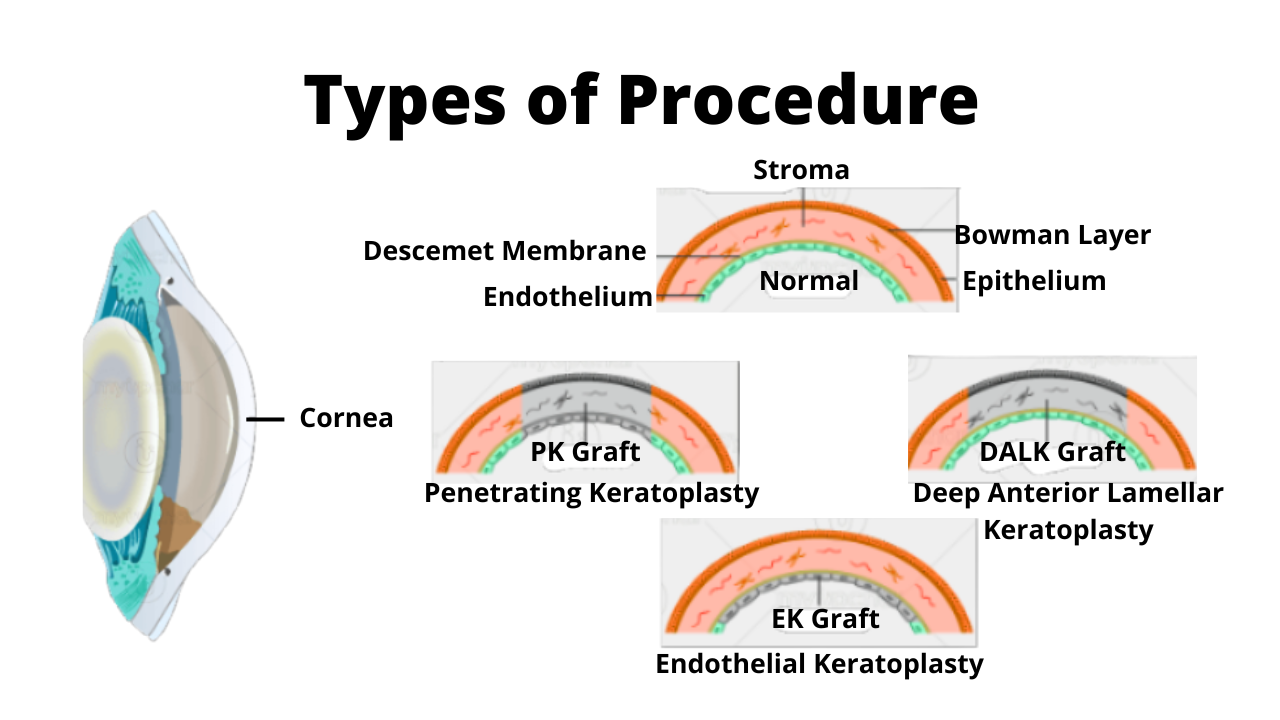  Types of procedures for Corneal Transplant.