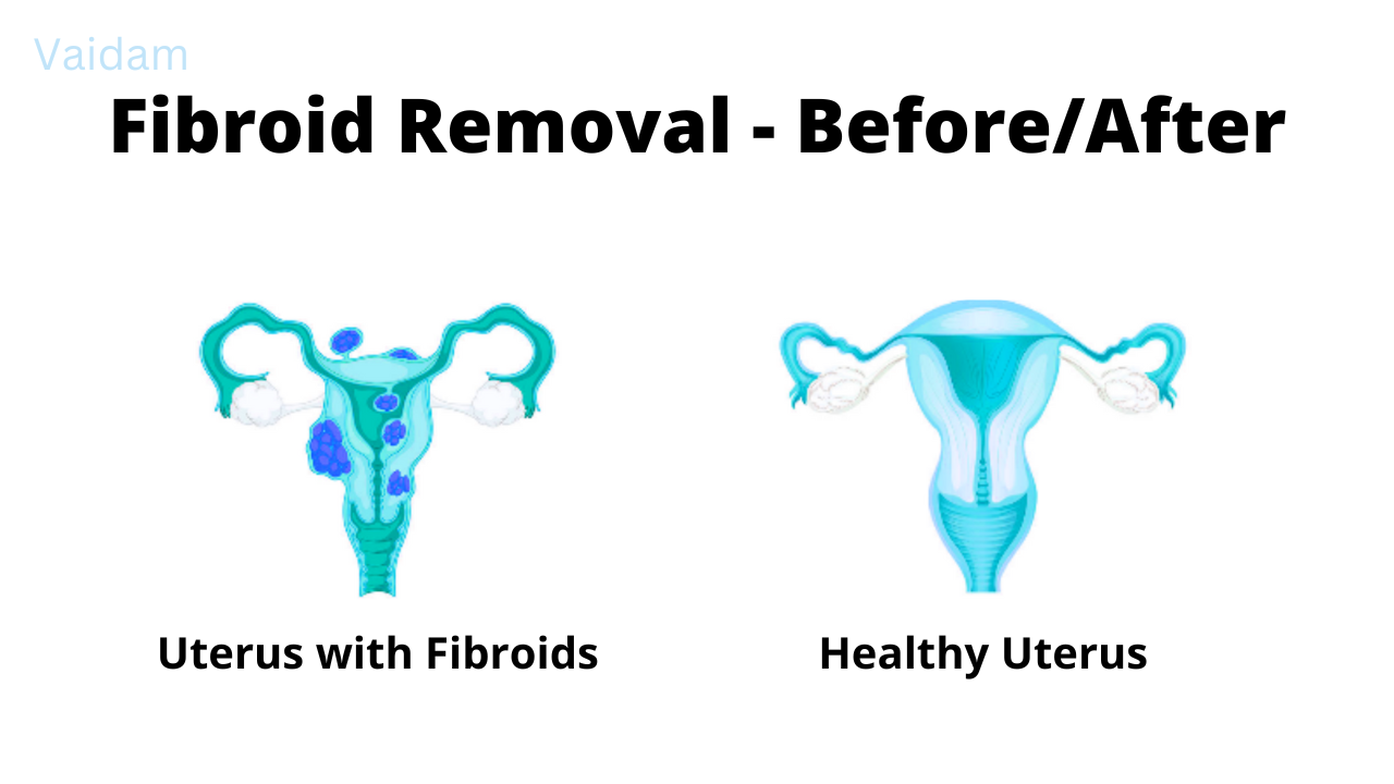 Before and after the Fibroid Removal Surgery.
