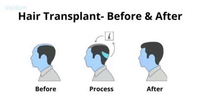  Before and after of hair transplant procedure.