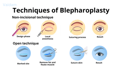  Techniques in Blepharoplasty.