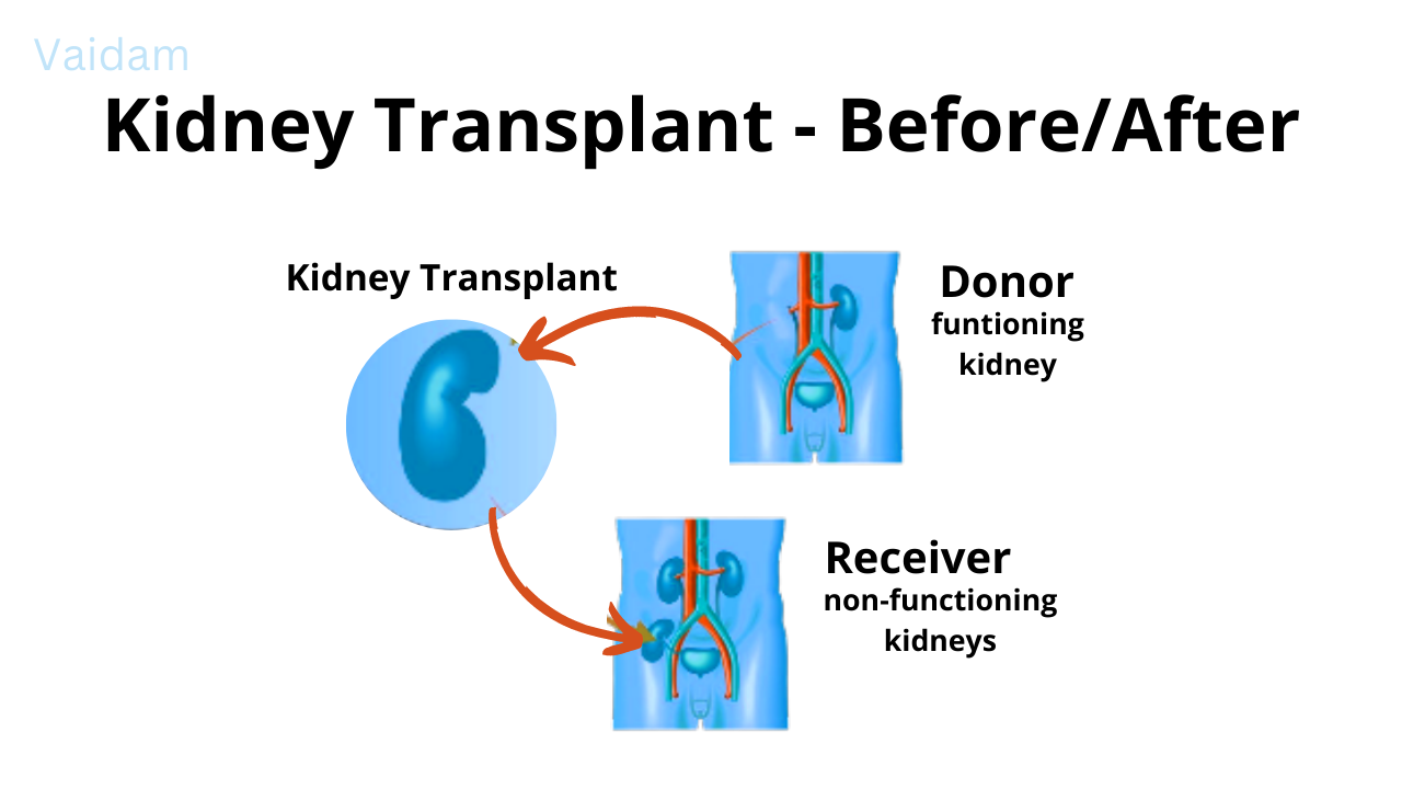 Before and after of Kidney Transplant.