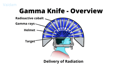 Gamma Knife treatment overview.
