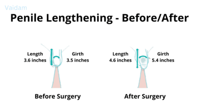 Before and after images of Penile Lengthening surgery.