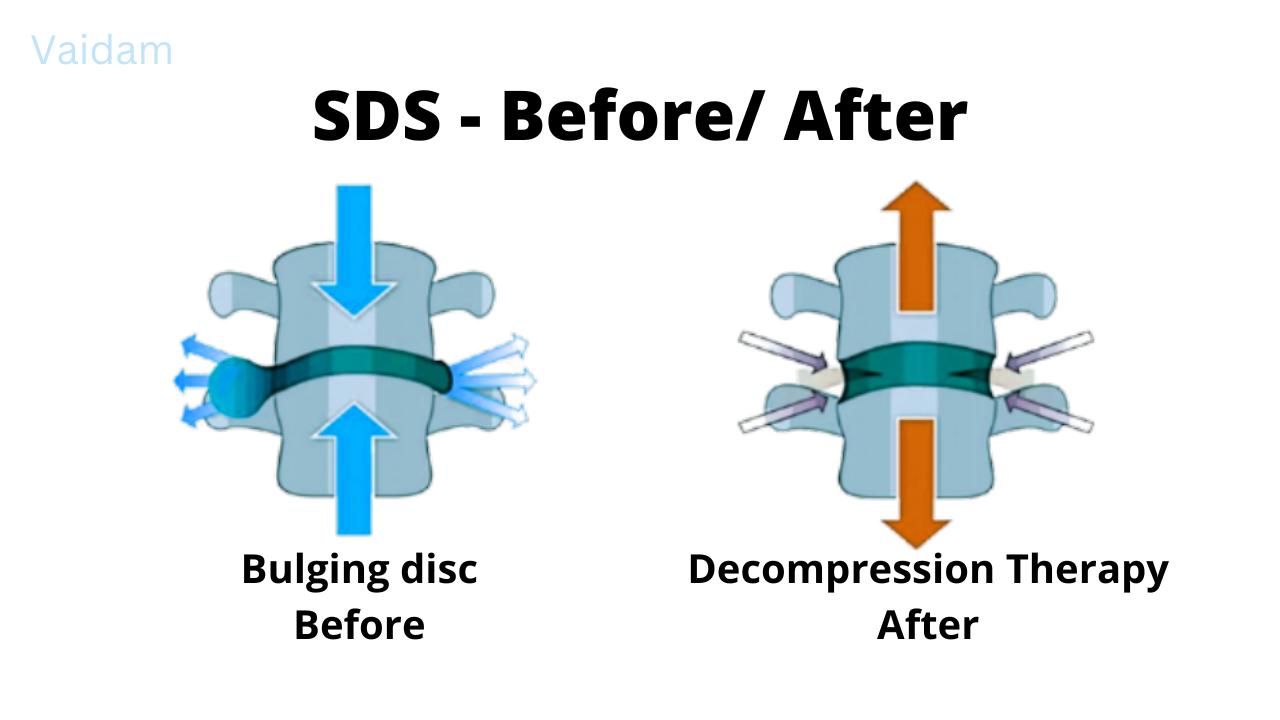 Before and after Spinal Decompression.