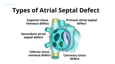  Types of Atrial Septal Defect.
