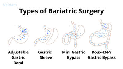 Types of Bariatric surgery.