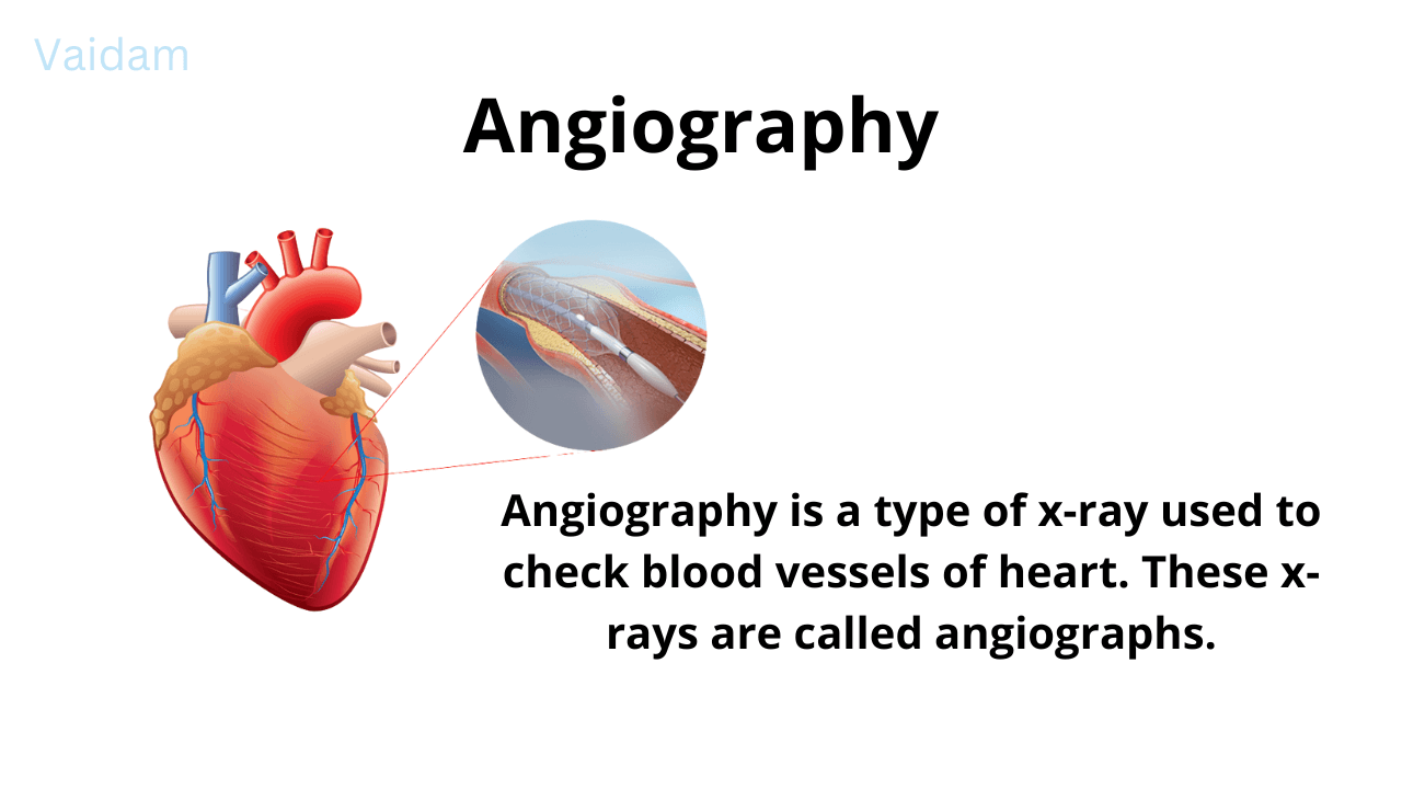 About Angiography.