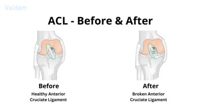 Before and after Anterior Cruciate Ligament treatment. 