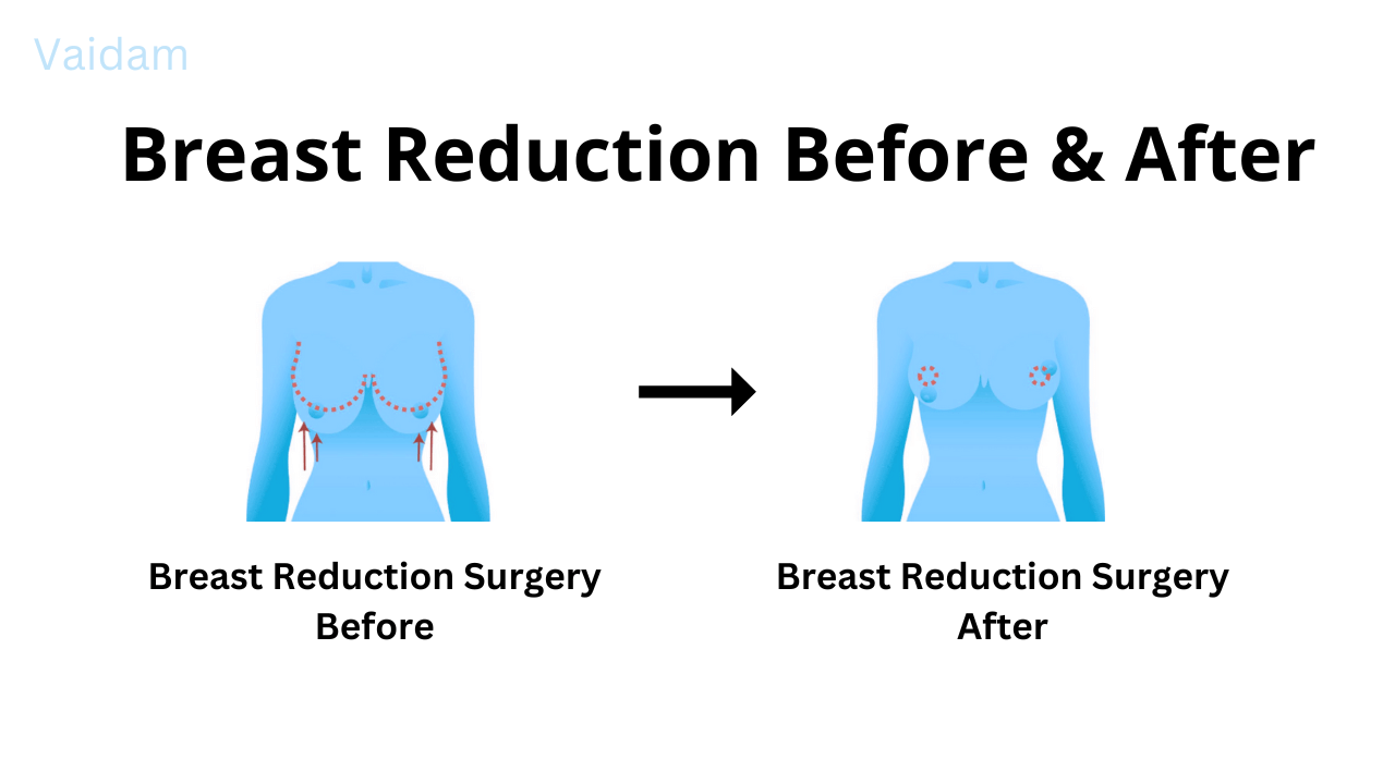 Avant et après la chirurgie de réduction mammaire.