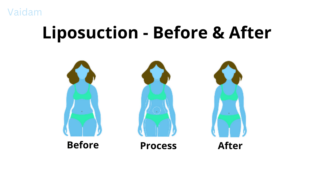  Before and after Liposuction surgery.