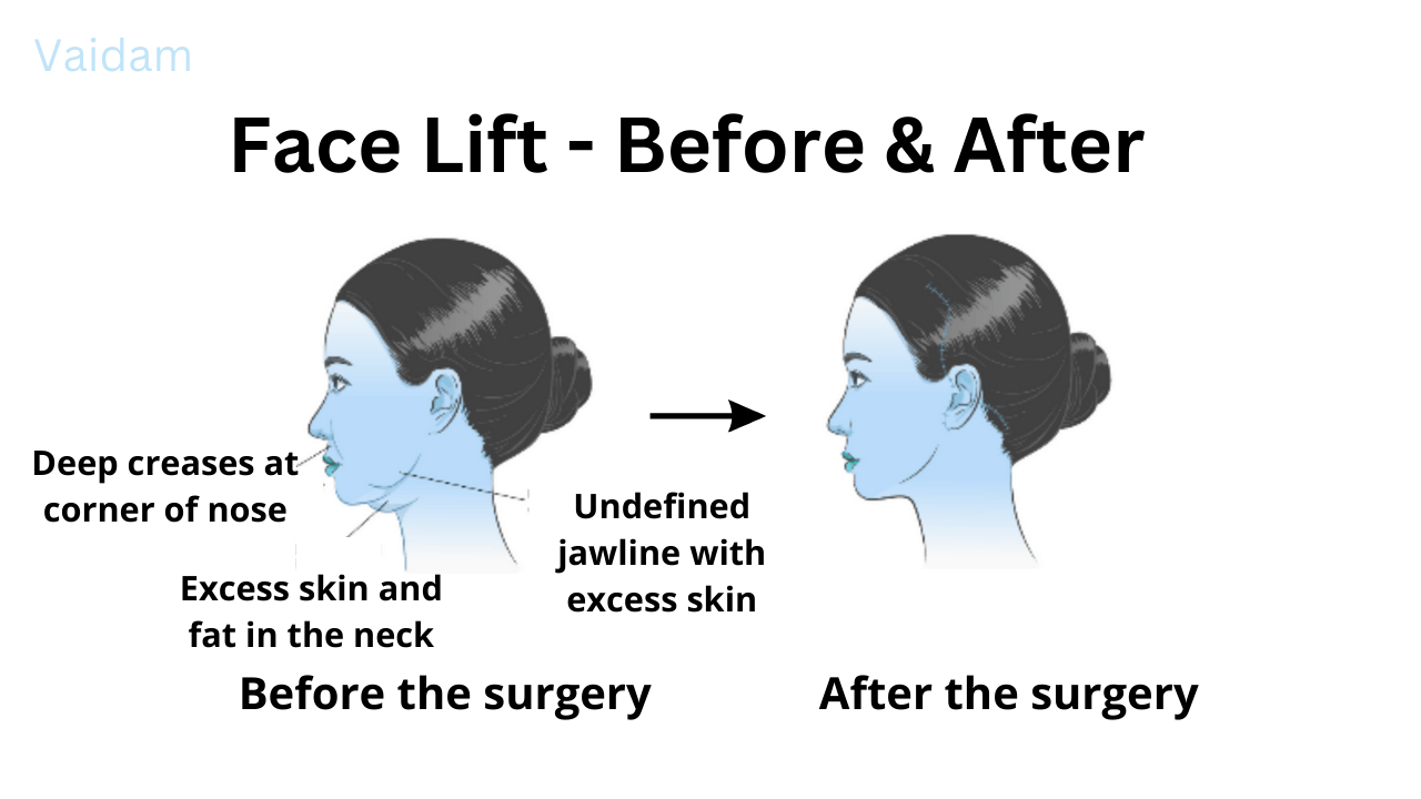  Before and after Face Lift surgery.