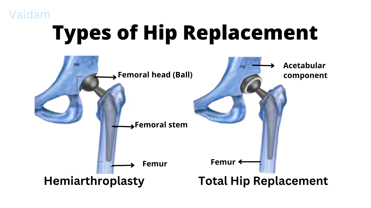 Types of Hip Replacement Surgery