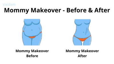 Before and after image of Mommy Makeover procedure.