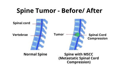 Before and after Spine Tumor surgery.