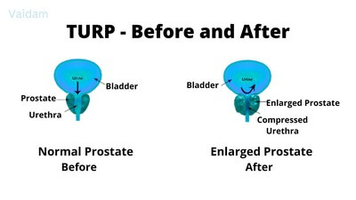 Before and after image of TURP treatment.
