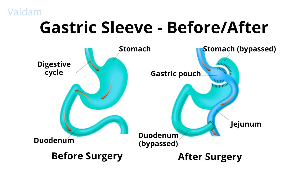 До и после операции по рукавной резекции желудка
