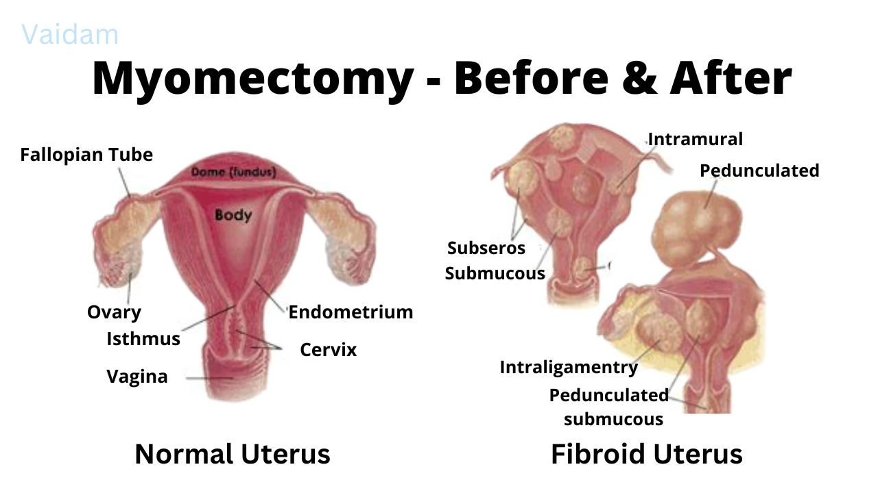 Before and after Myomectomy Surgery.