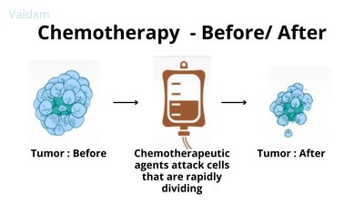 Before and after images for chemotherapy.