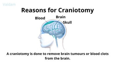 Reasons for Craniotomy.