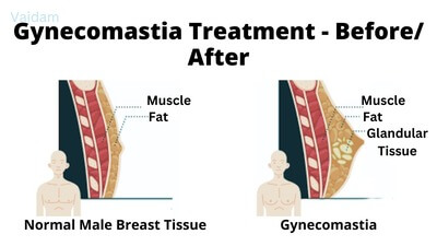 Before and after Gynecomastia treatment.
