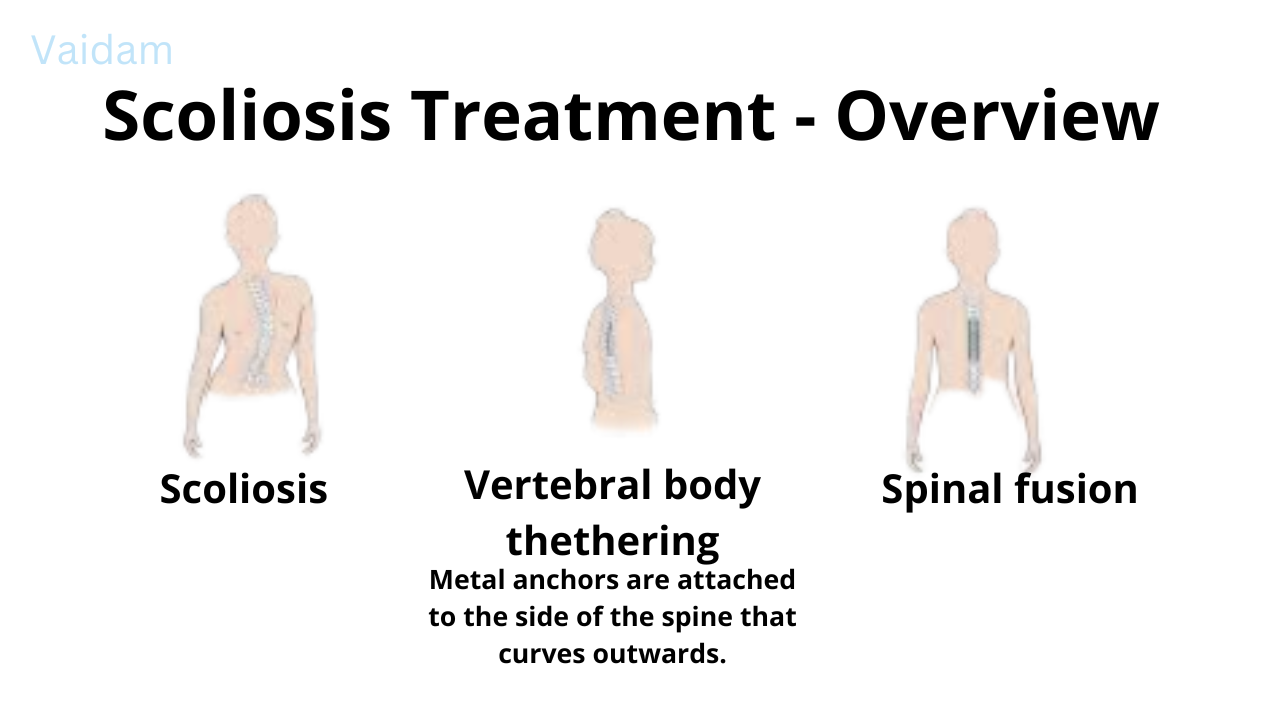  Overview of Scoliosis treatment.